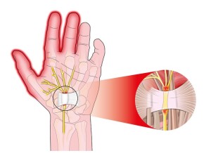 White band is the transverse carpal ligament